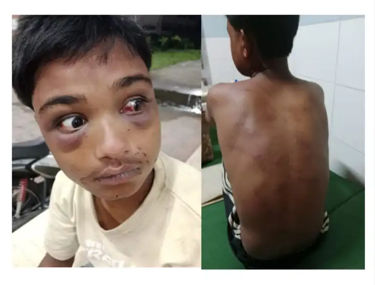 নির্যাতিত কিশোরের দুই চোখ ও চুরির মামলায় ফাঁসানোর মুল্য আড়াইল লক্ষ টাকা