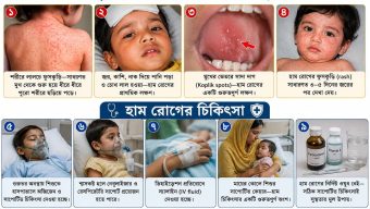 সিলেটে হামের উপসর্গে আরও তিন শিশুর মৃত্যু