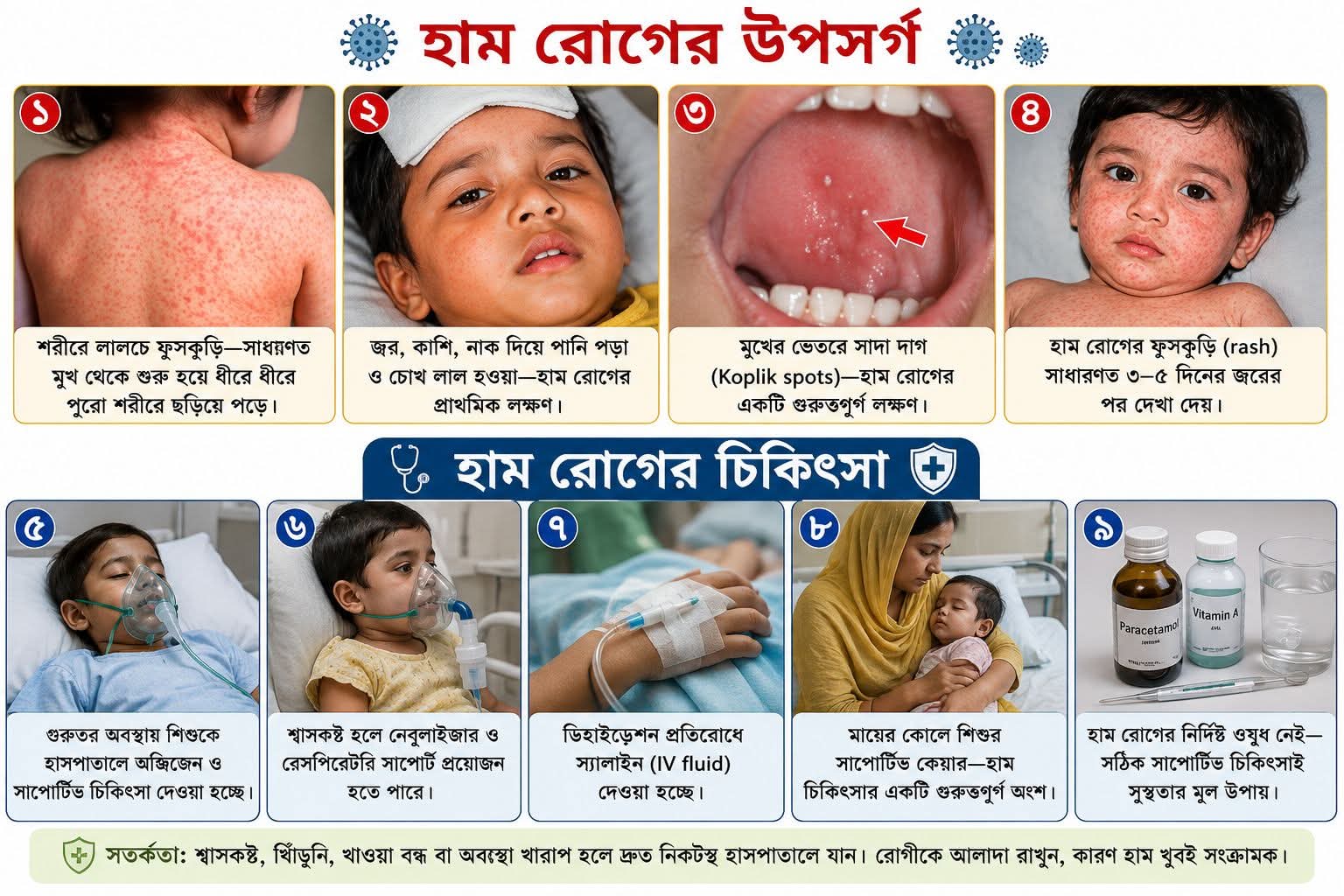 সিলেটে হামের উপসর্গে আরও তিন শিশুর মৃত্যু