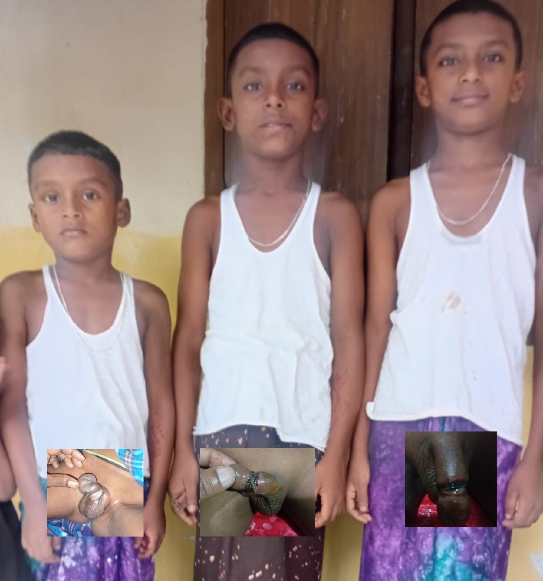 নবীগঞ্জে খতনার পর ৩ শিশুর শারীরিক জটিলতা